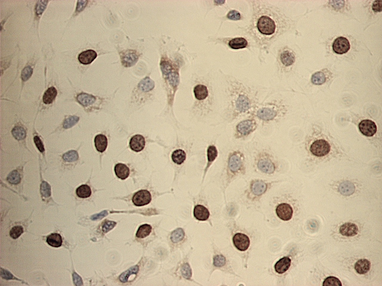 Figure 1: BrdU labeled MCF-7 cells immunostained using the X1545K.1 kit. Note the specific nuclear staining of proliferating S-phase cells.